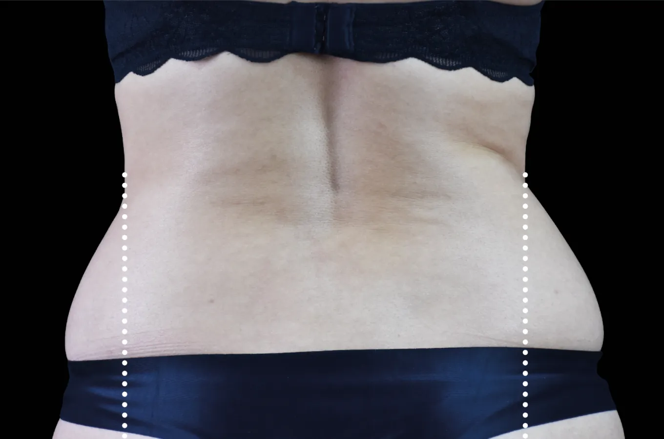 BTL EMSCULPT NEO före-behandling, lateral abdominalvy på kvinnlig patient.