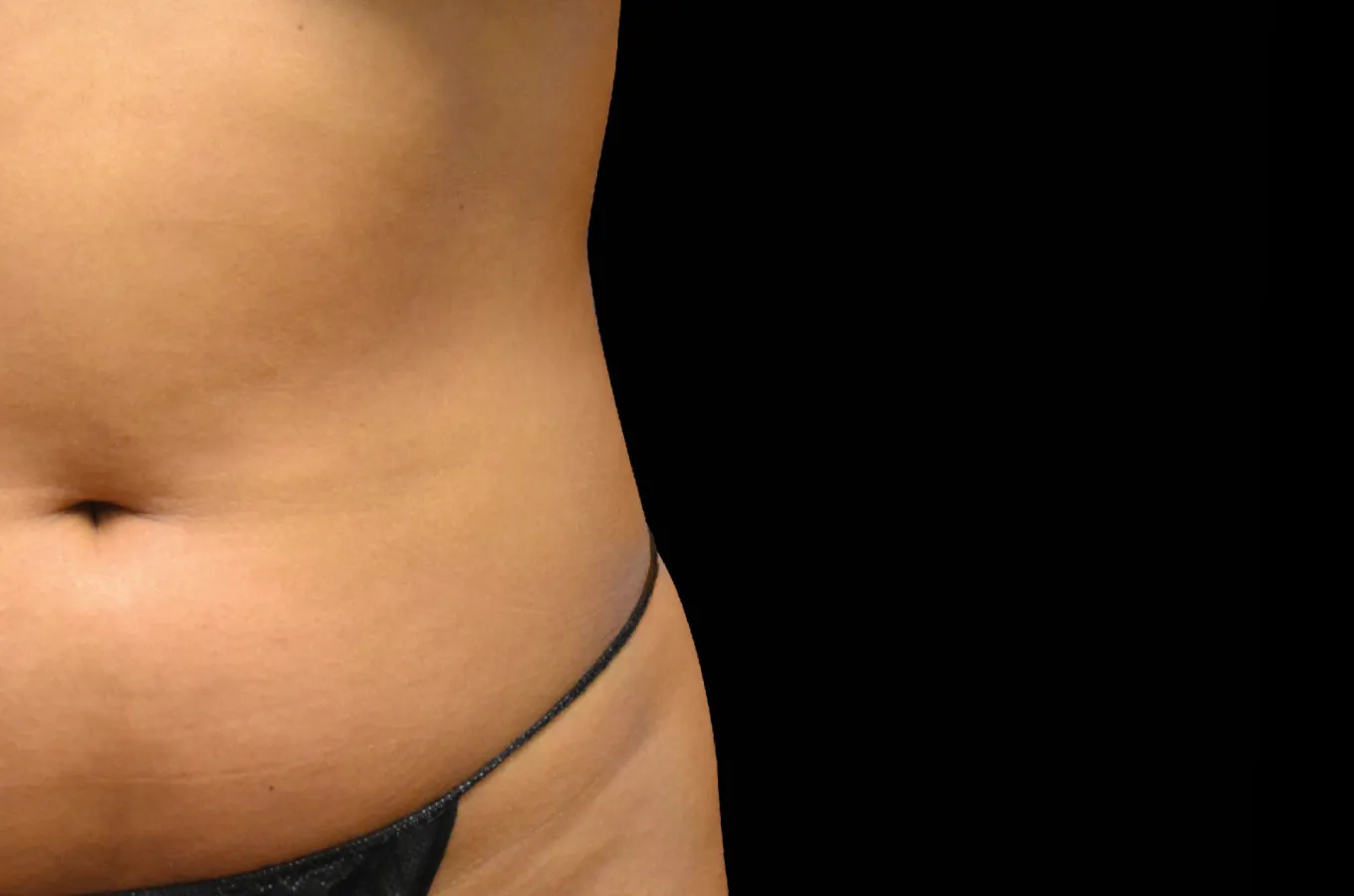 Lateralvy av bukregion efter BTL EMSCULPT NEO-behandling som visar definierad muskulatur.