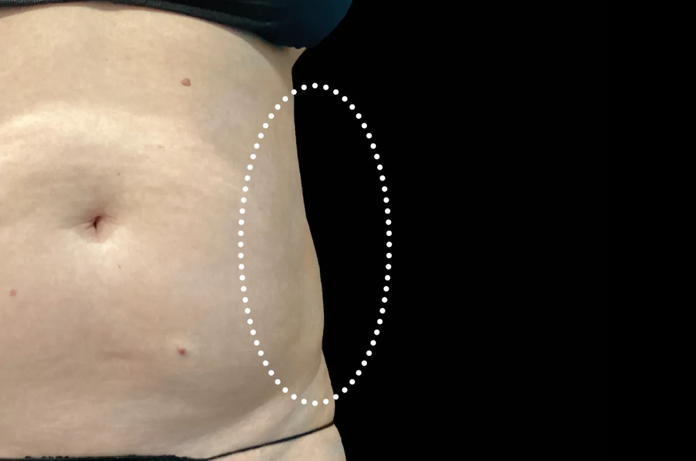 BTL EMSCULPT NEO behandlingsresultat visar definierad bukväggsmuskulatur från lateral sida efter behandling.