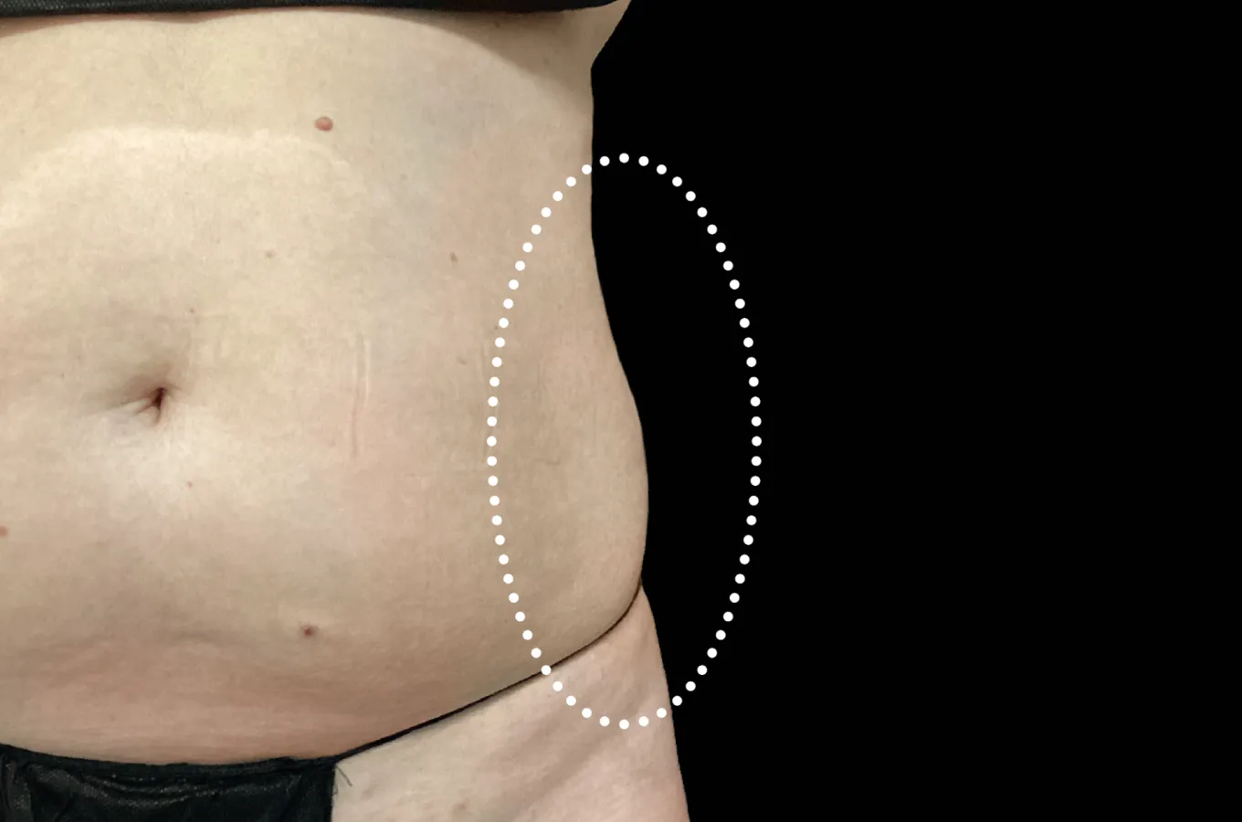 Lateralvy av abdomen före behandling med BTL EMSCULPT NEO.