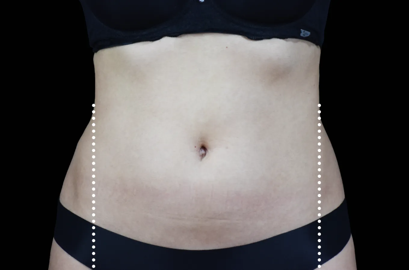 BTL EMSCULPT NEO behandlingsresultat visar senare skede av sidovy på kvinnors buk med definierad muskulatur.