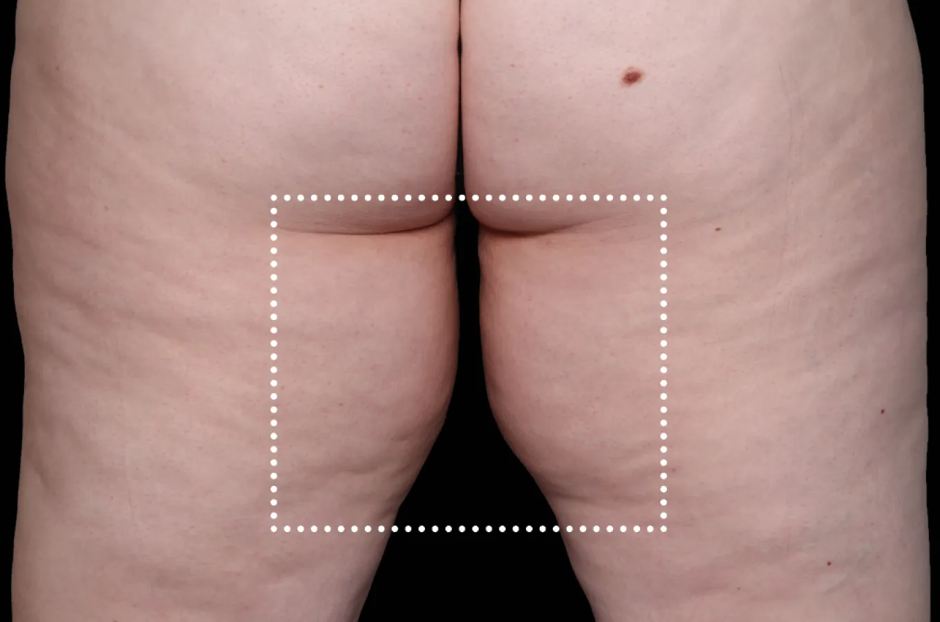 Baksida av kvinnas innerolaar efter BTL EMSCULPT NEO-behandling, visar straffad hud och minskad celluliter.