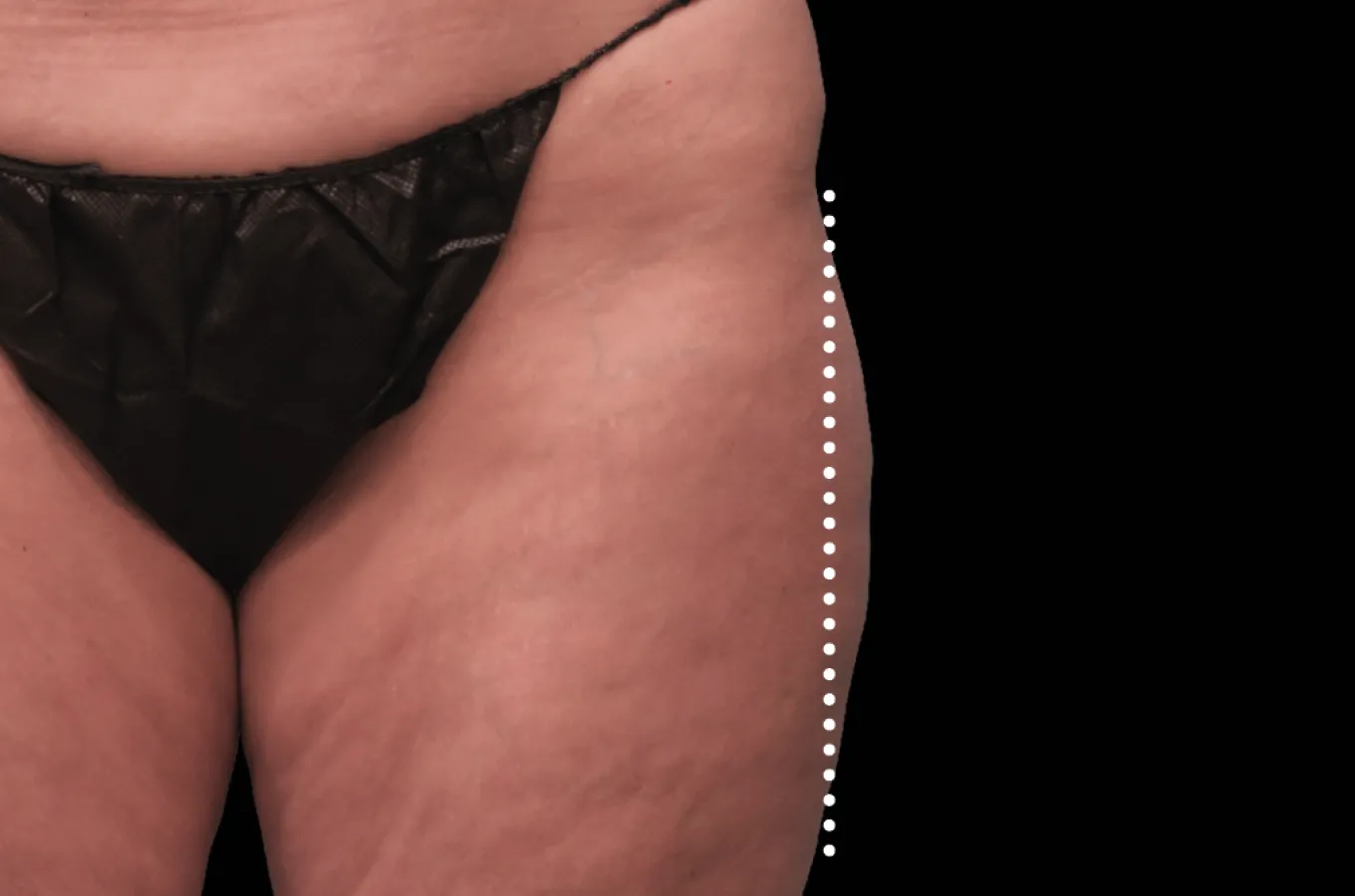 Kvinnas yttre lår efter behandling med BTL EMSCULPT NEO, visar straffad och definierad muskulatur.