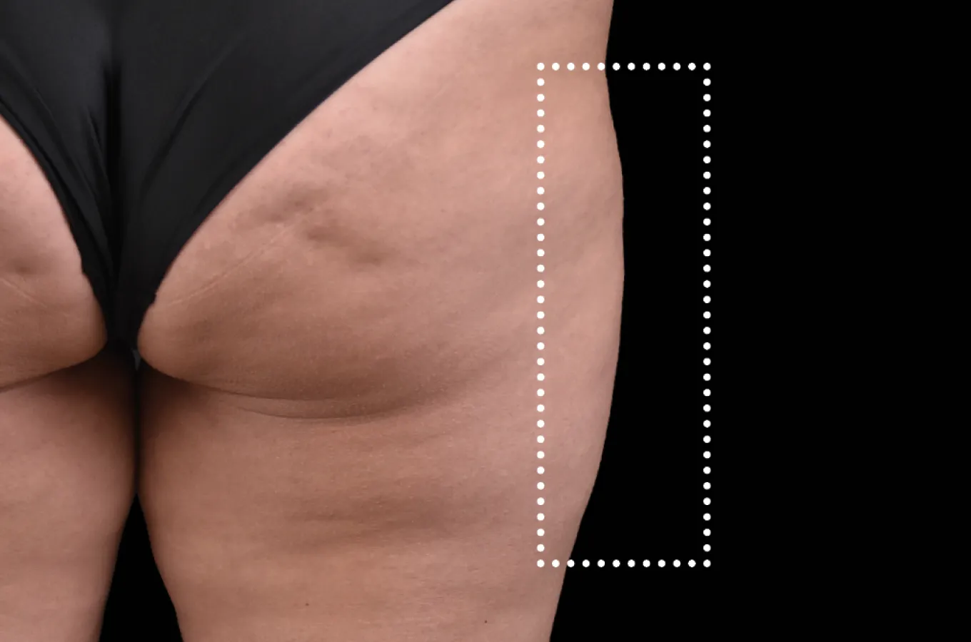 Kvinnlig bål från sidan före BTL EMSCULPT NEO-behandling av låren.