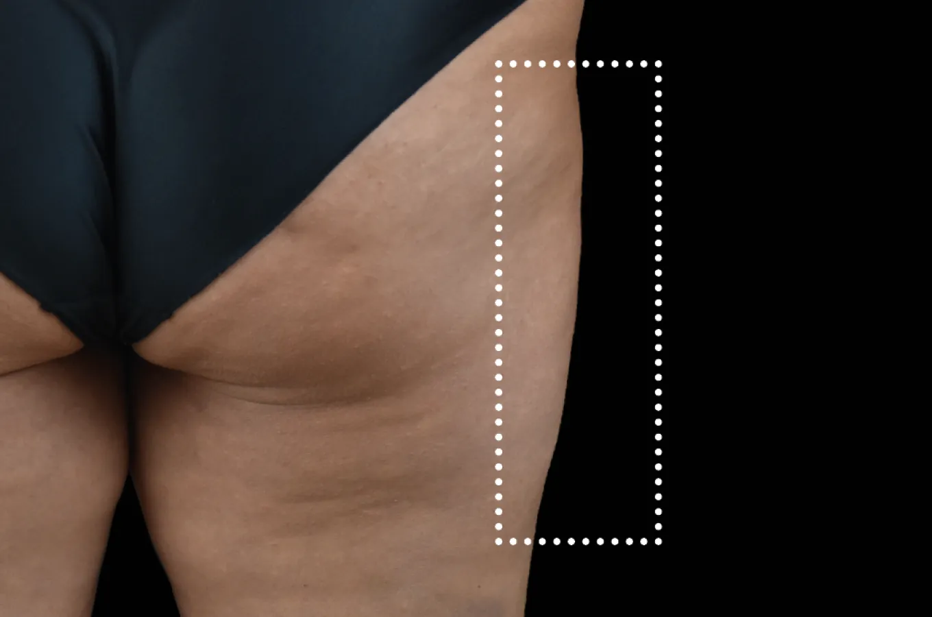 Yttre lår efter behandling med BTL EMSCULPT NEO, visar resultat på kvinnlig patient.