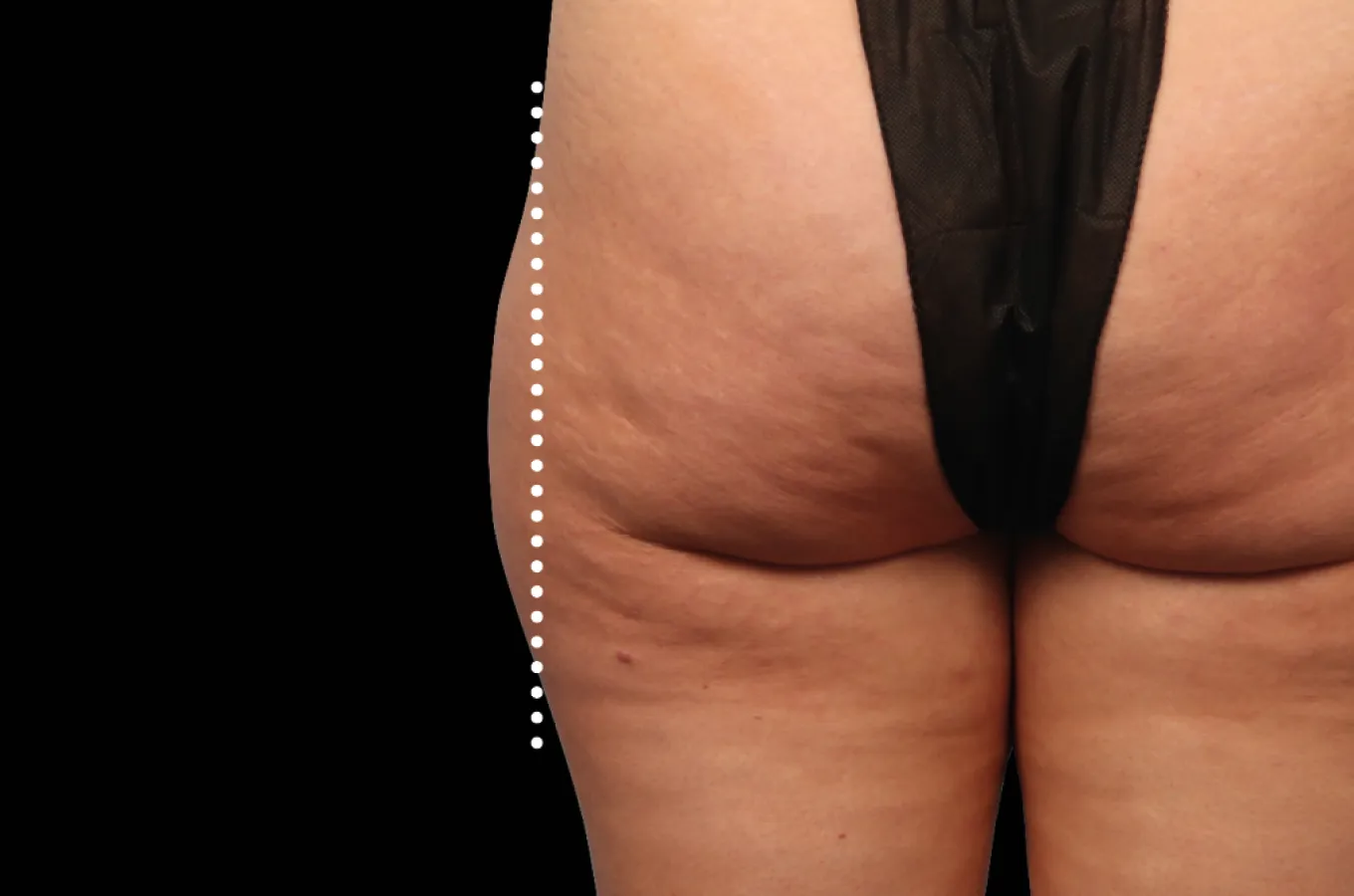 Baksida av lår efter EMSCULPT NEO-behandling med BTL-teknik.