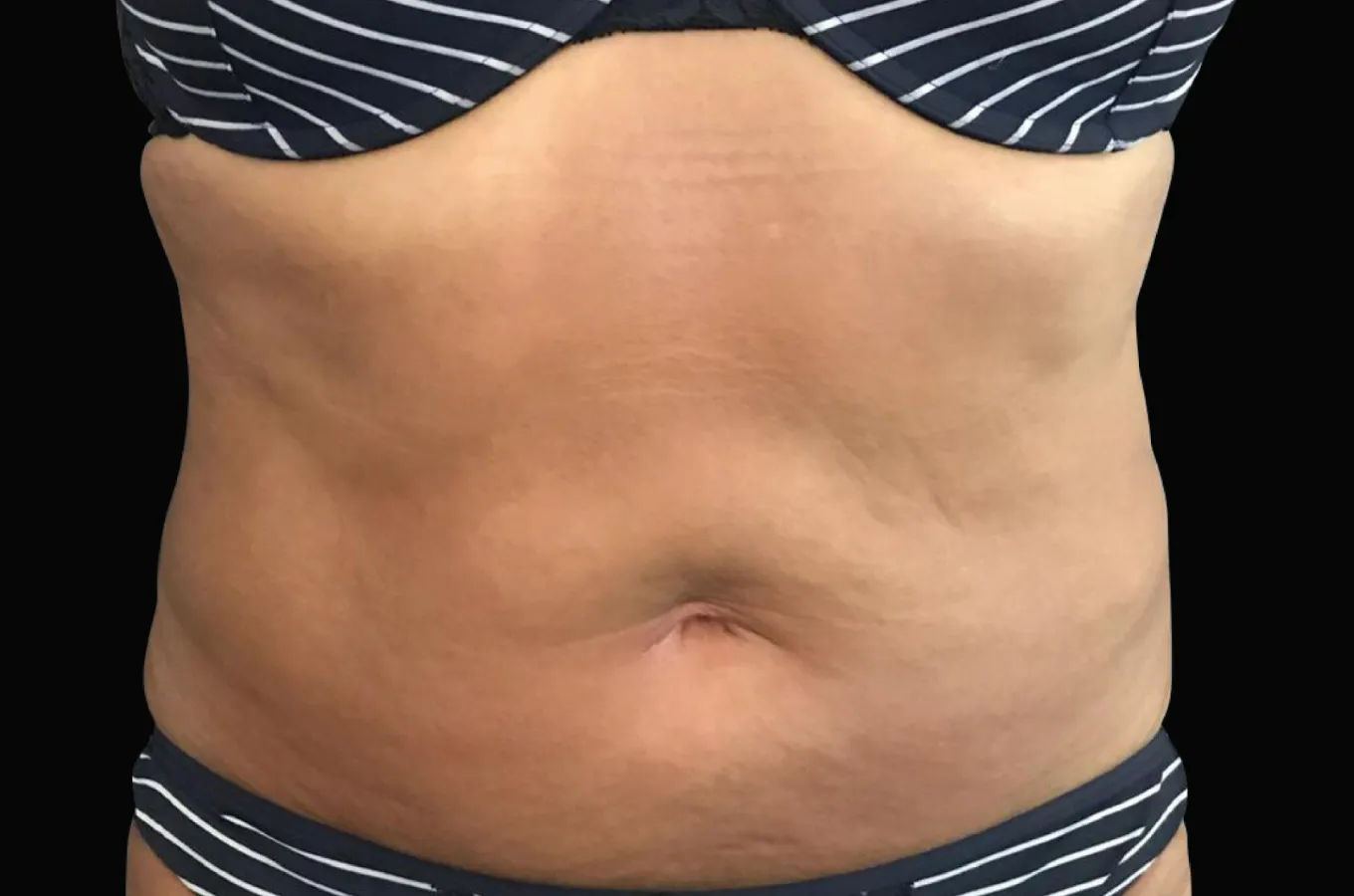 Bukväggen på en kvinnlig patient efter behandling med BTL EXILIS ULTRA 360.