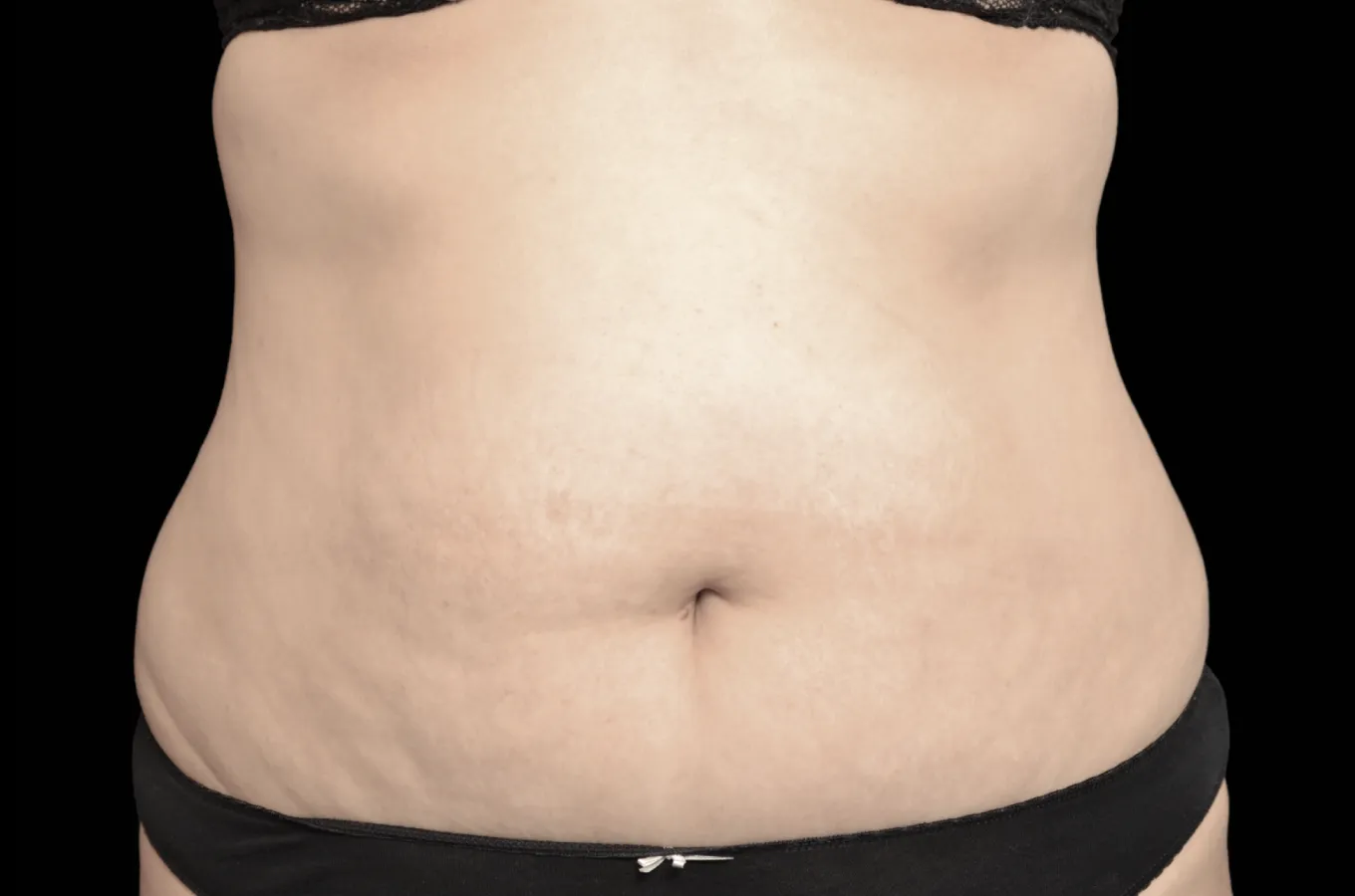 Kvinnas buk efter behandling med BTL EXILIS ULTRA 360, frontalvy.
