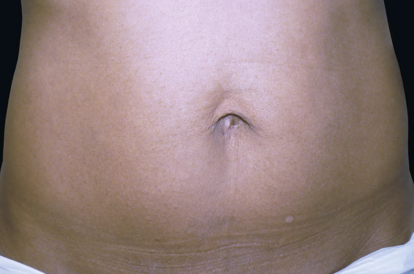 Kvinnas buk efter behandling med BTL EXILIS ULTRA 360.