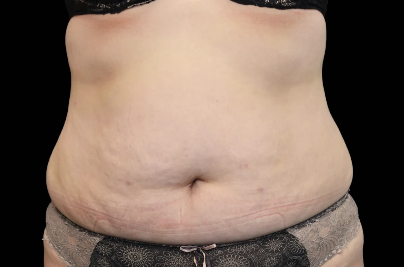 Kvinnas mage före behandling med BTL EXILIS ULTRA 360.