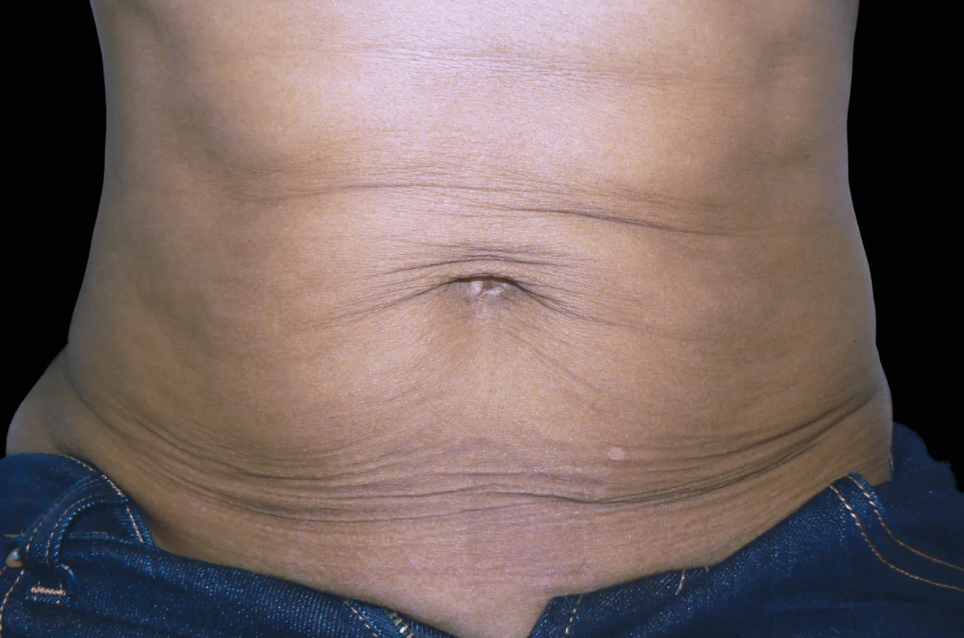 Före-behandlingsfoto av en kvinnas mage, taget för BTL EXILIS ULTRA 360-behandling.