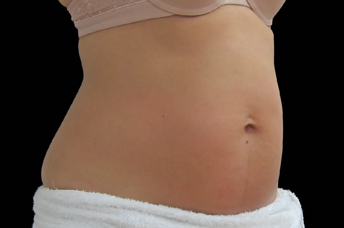 Kvinnors buk efter BTL EXILIS ULTRA 360-behandling visar straffad hud och reducerad fettvävnad.
