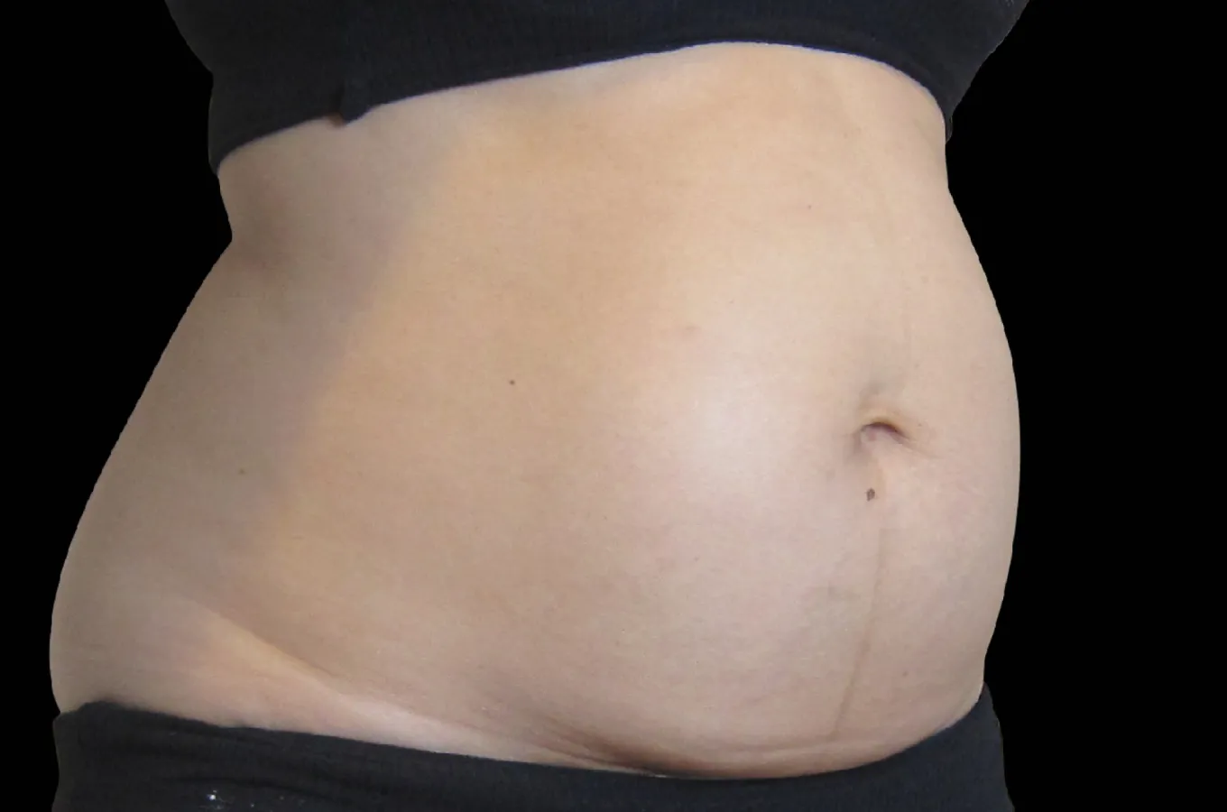Kvinnas mage före behandling med BTL EXILIS ULTRA 360.
