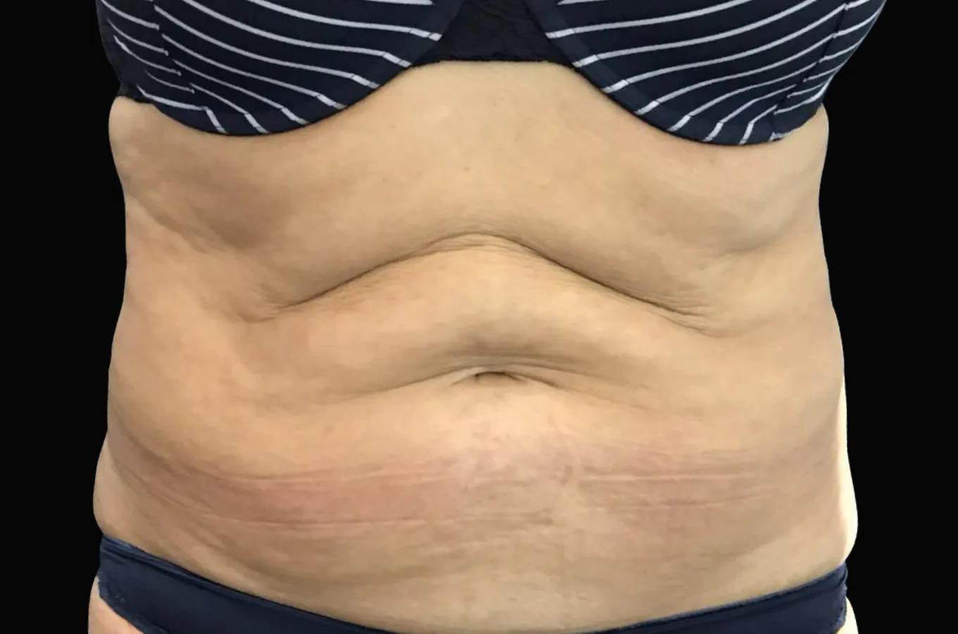 BTL EXILIS ULTRA 360 behandling före, bukområde frontvyn på kvinna med mage.