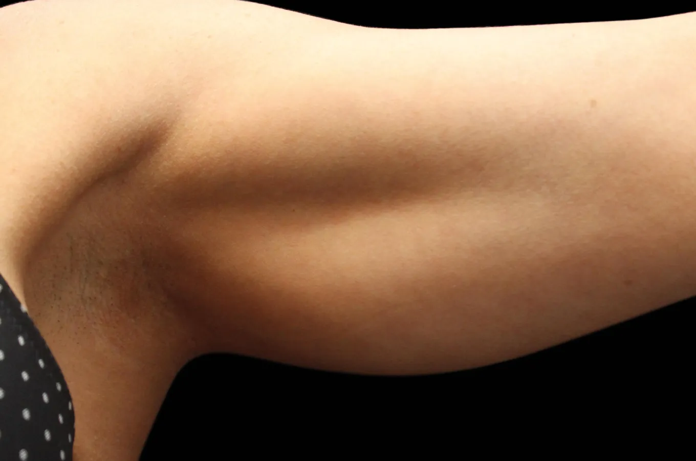 Kvinnliga armar efter behandling med BTL EXILIS ULTRA 360, visar straffad hud och förbättrad kontur.