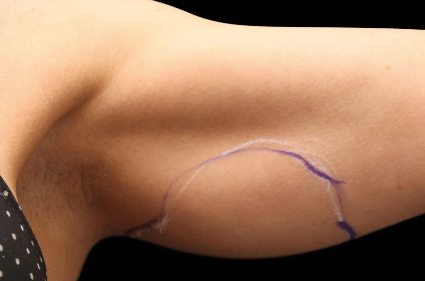 Kvinnlig arm sett från sidan före behandling med BTL EXILIS ULTRA 360.