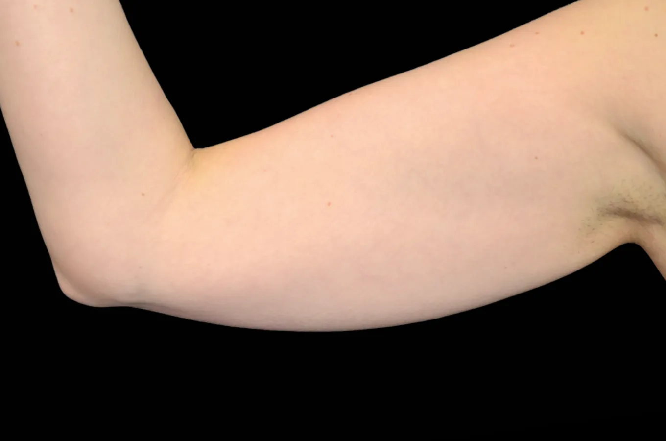Kvinnliga armar från framsidan före behandling med BTL EXILIS ULTRA 360.