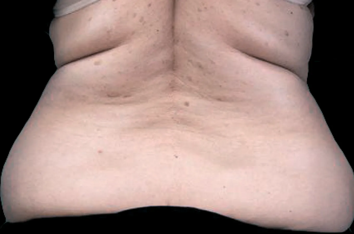 BTL EXILIS ULTRA 360 före-behandling av bak- och kvartalsområde.