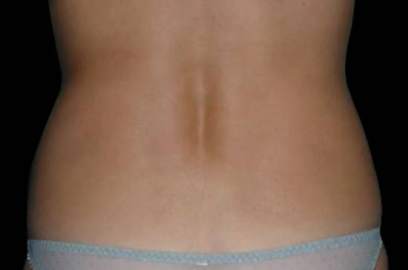 Kvinnas rygg efter BTL EXILIS ULTRA 360-behandling visar reducerad volym vid handlekanter.