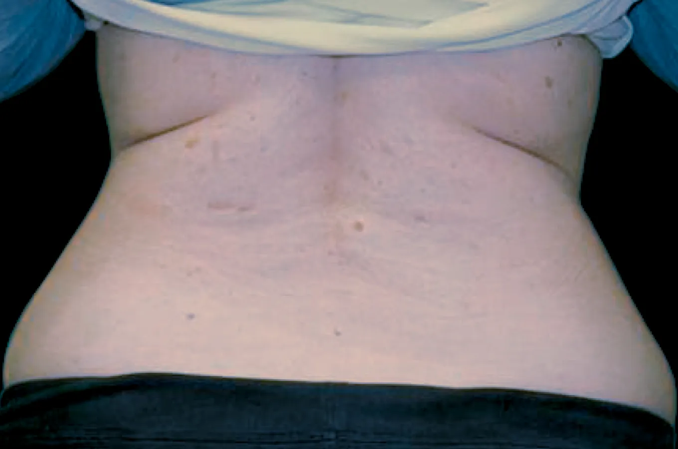 Bakvy av rygg efter BTL EXILIS ULTRA 360-behandling som visar reducerad fettvävnad på sidorna.