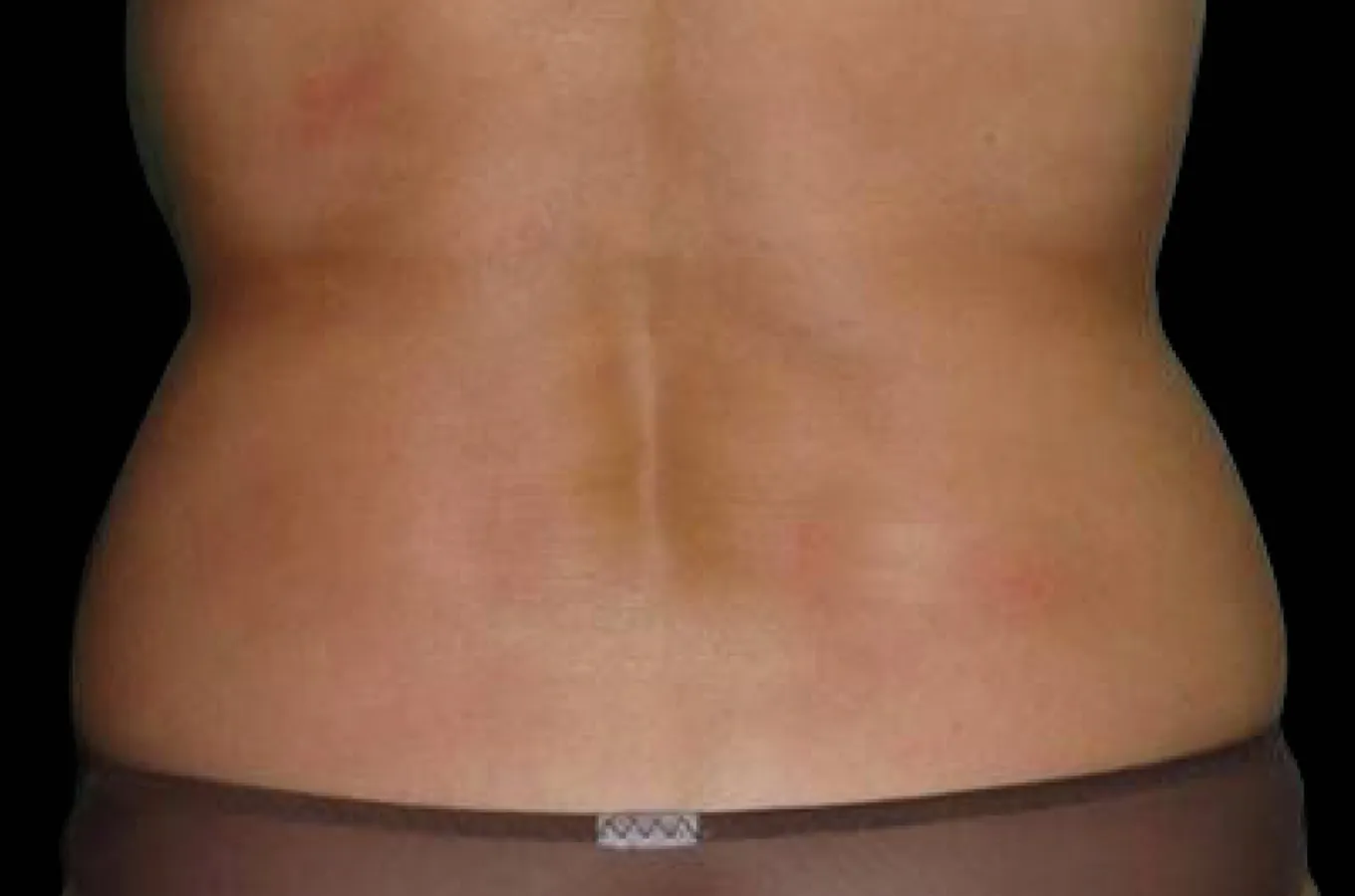 Bakvy av kvinnas rygg före BTL EXILIS ULTRA 360-behandling mot kärlek och fettansamling.