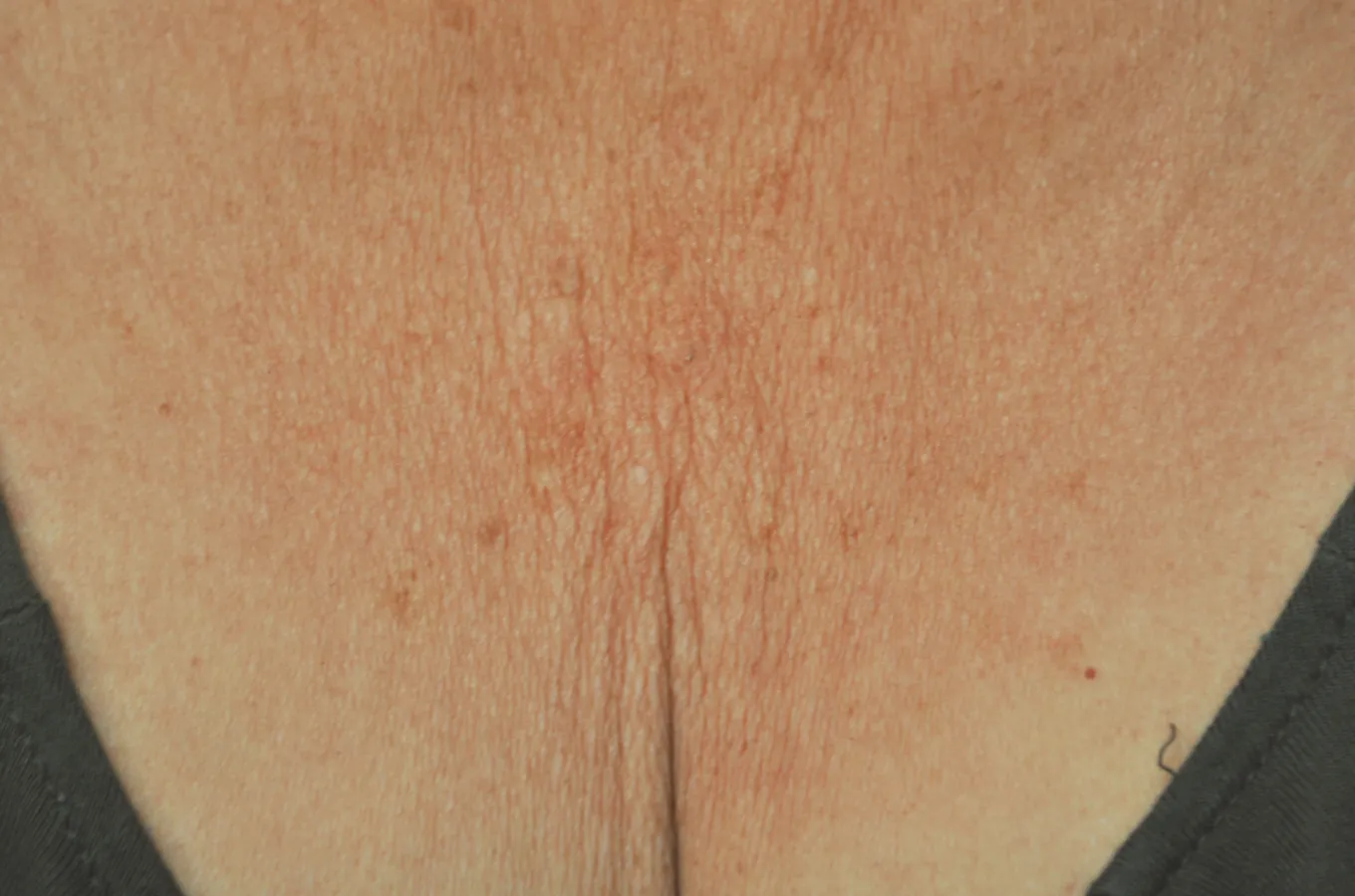 Dekolletage före behandling med BTL EXILIS ULTRA 360.