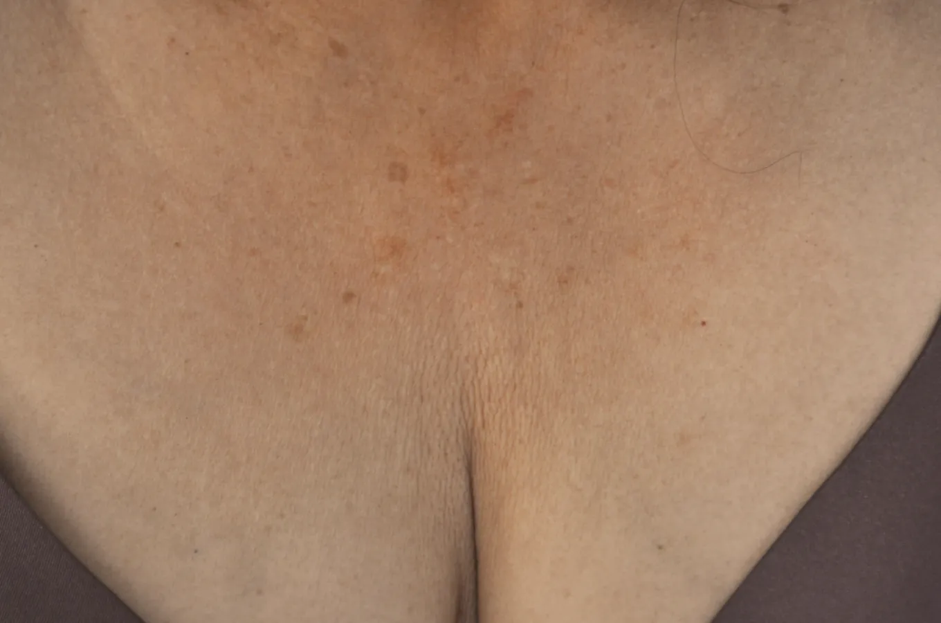 Kvinnlig dekollete efter behandling med BTL EXILIS ULTRA 360.