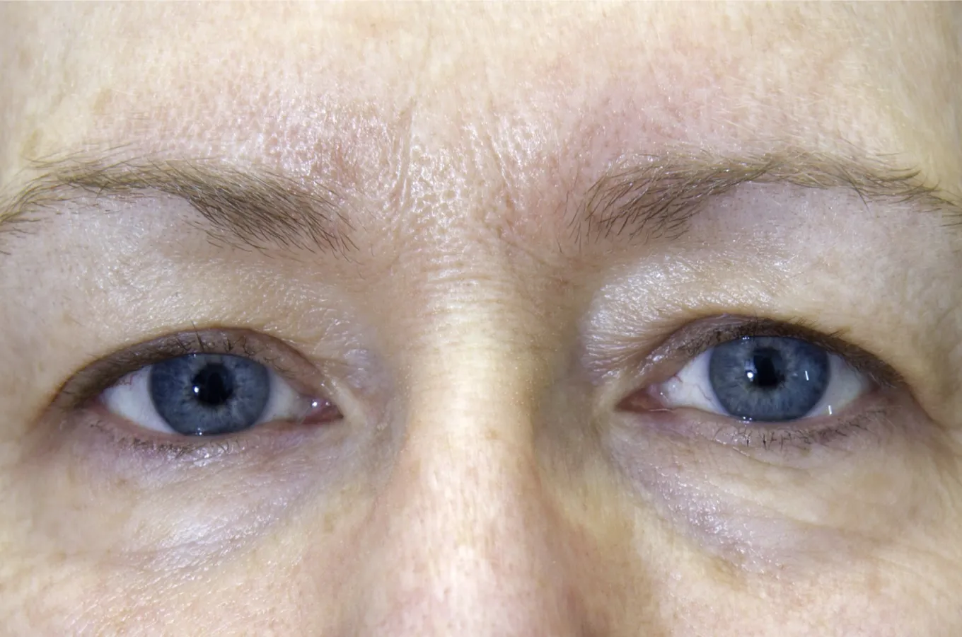 Närbild på ögon efter behandling med BTL EXILIS ULTRA 360, visar minskad svullnad och förbättrad hutkvalitet.