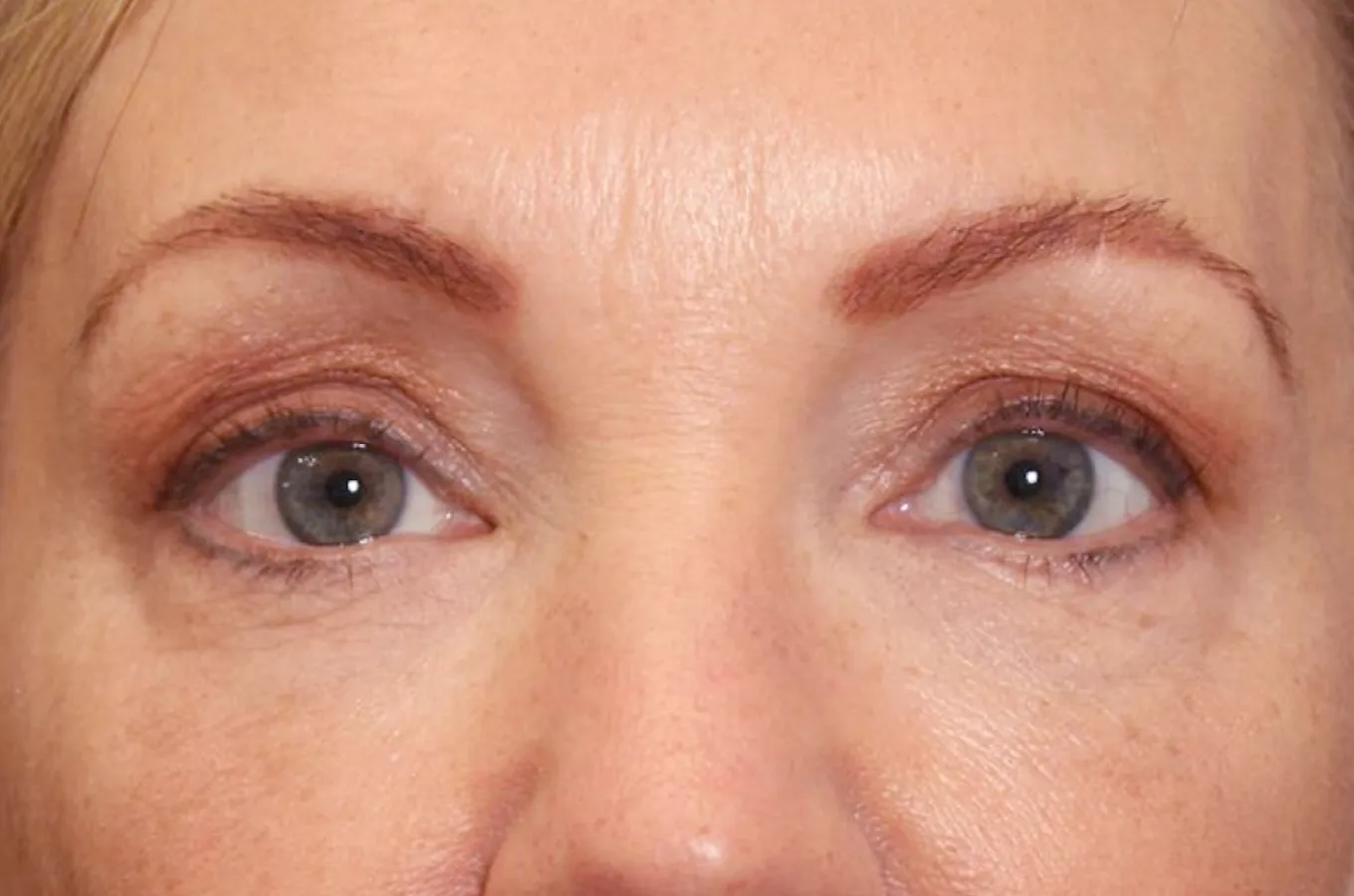 Ögon efter behandling med BTL EXILIS ULTRA 360, visar reducerad fåror och straffad hud omkring ögonområdet.
