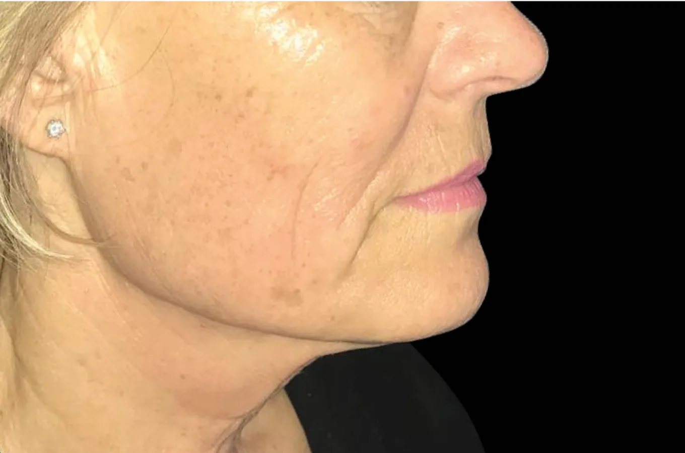 Kvinnans ansikts- och halssida efter BTL EXILIS ULTRA 360-behandling visar straffad hudstruktur.