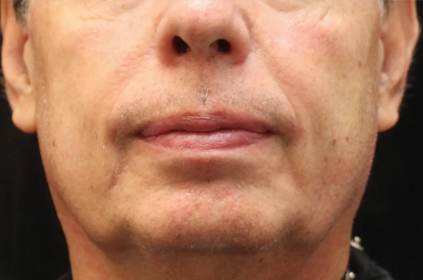 Mans ansikte efter EXILIS ULTRA 360-behandling från BTL, framifrån.
