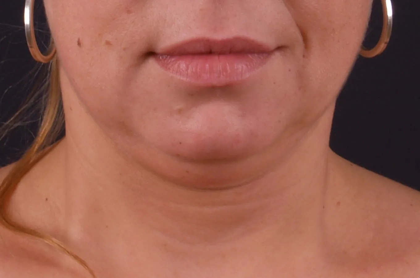 Kvinnas ansikte framifrån före behandling med BTL EXILIS ULTRA 360.