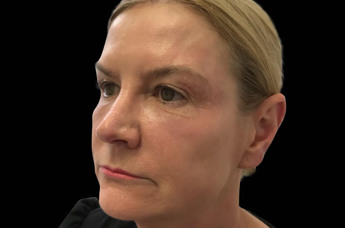Kvinnas ansikte och hals efter behandling med BTL EXILIS ULTRA 360, framifrån.