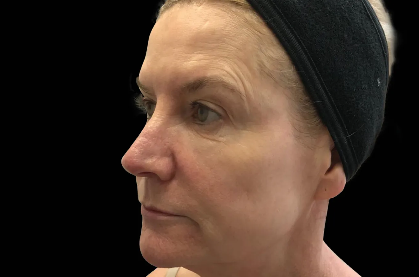 Kvinnas ansikte och hals före BTL EXILIS ULTRA 360-behandling, profilvy.