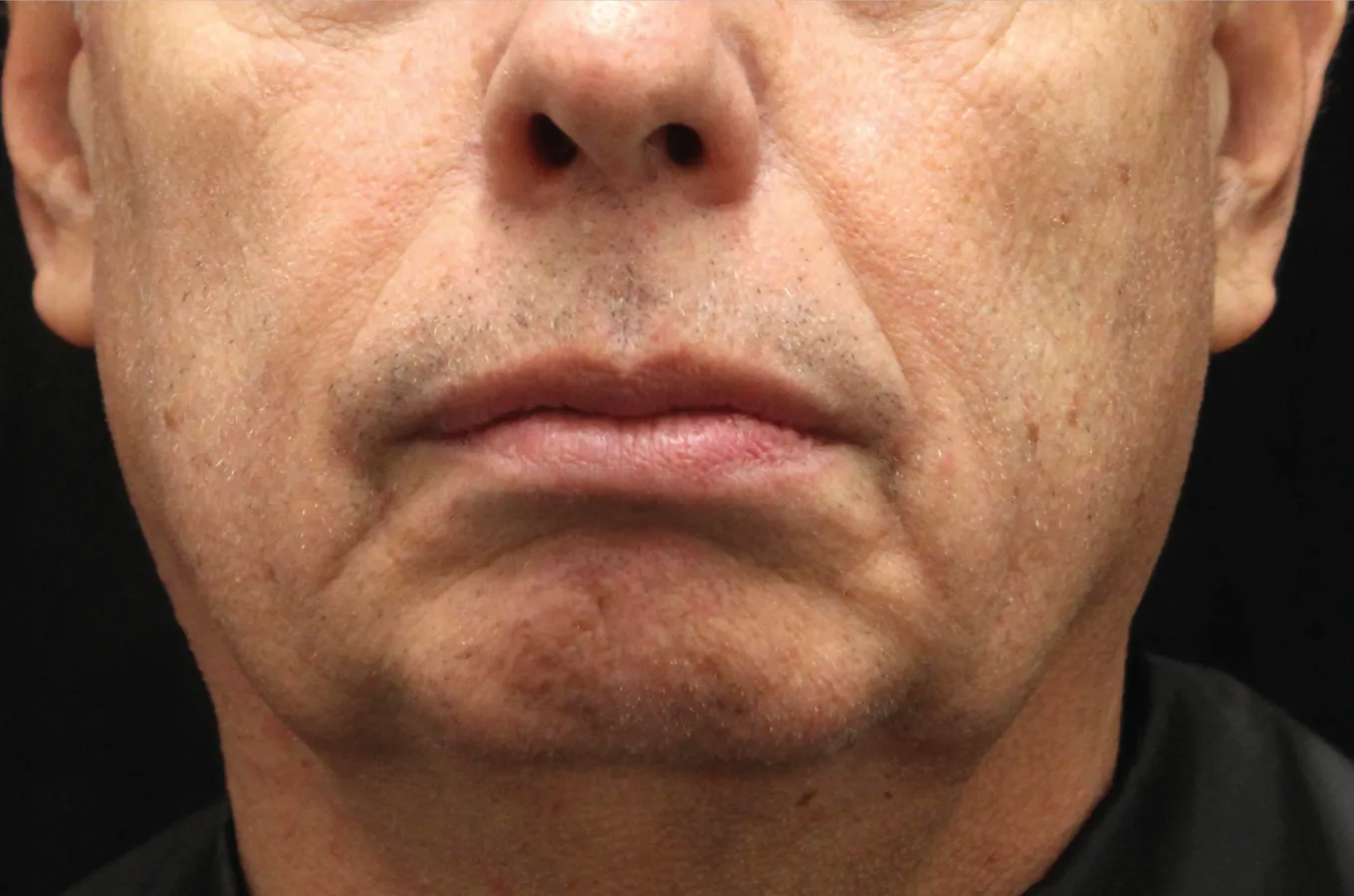 Man med motsvarande blick från fram, före behandling med BTL EXILIS ULTRA 360.