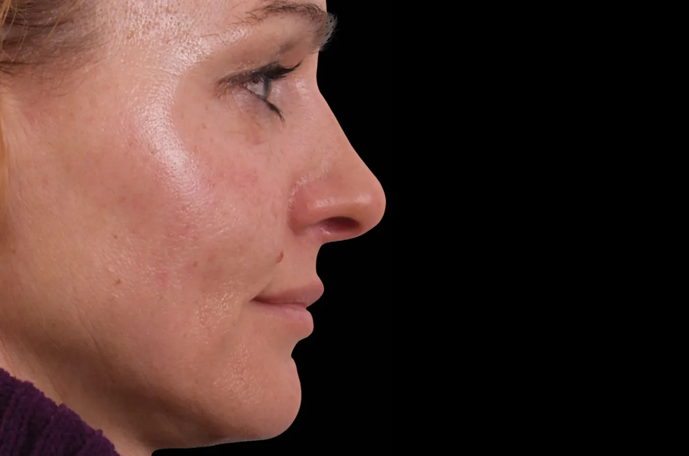 Kvinnas ansikte i profil efter BTL EXILIS ULTRA 360 behandling.