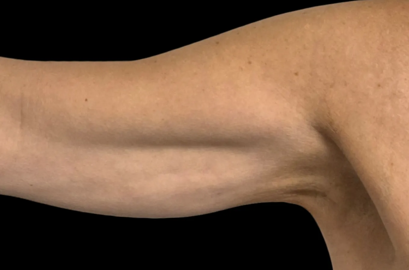Kvinnas arm från sidan före BTL EXION-behandling.