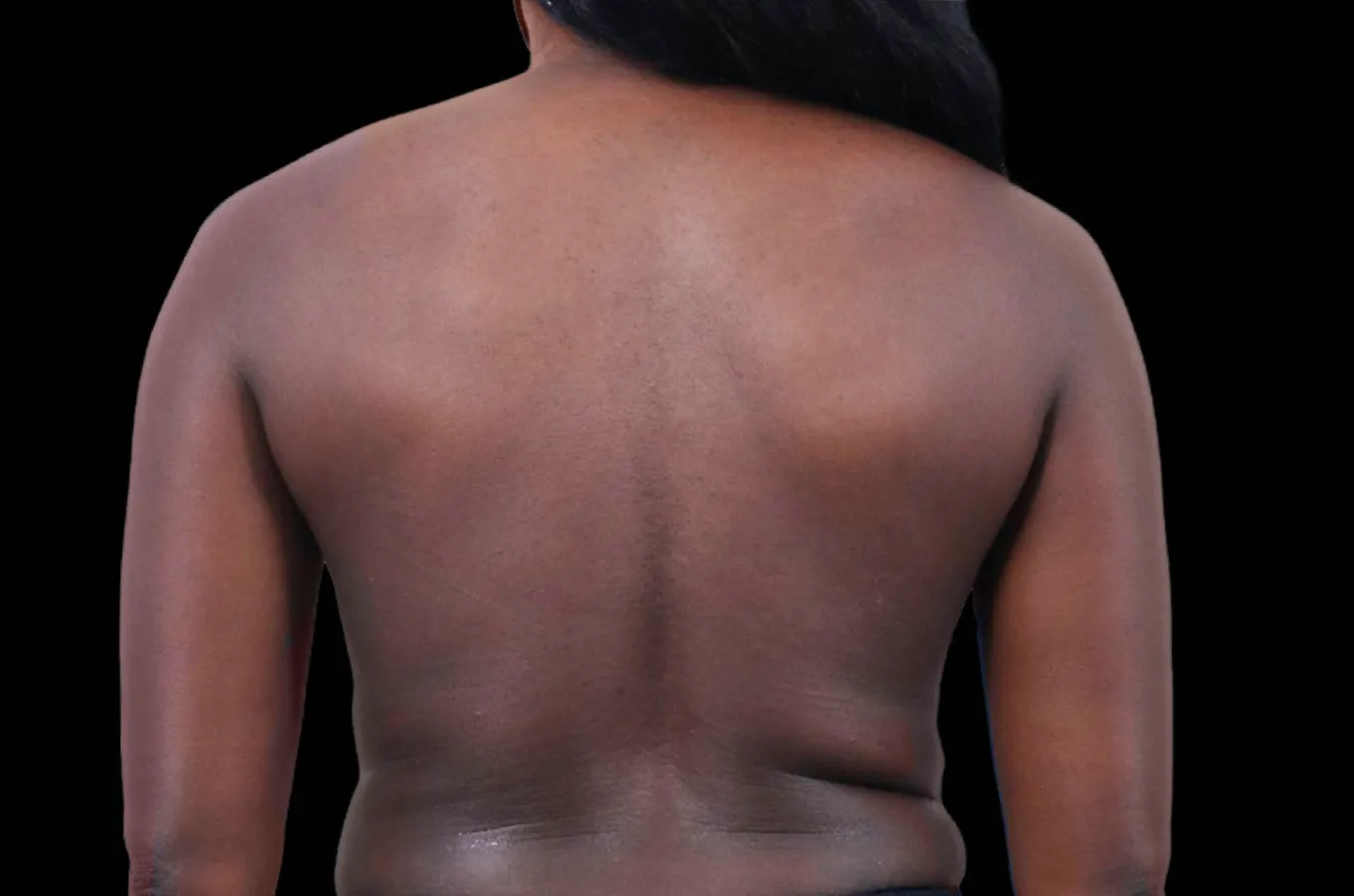 Baksida av kvinnlig torso före BTL EXION-behandling.