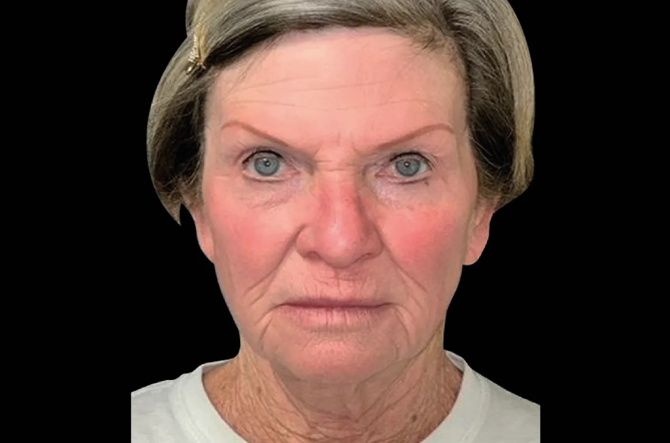 Kvinna efter kombinerad BTL EXION-behandling med förbättrad hudtextur och lyftad hudhållning.