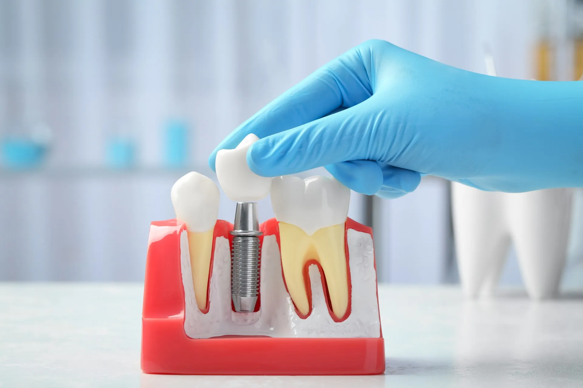 Patient smiling with a perfectly matched porcelain crown that blends seamlessly with natural teeth