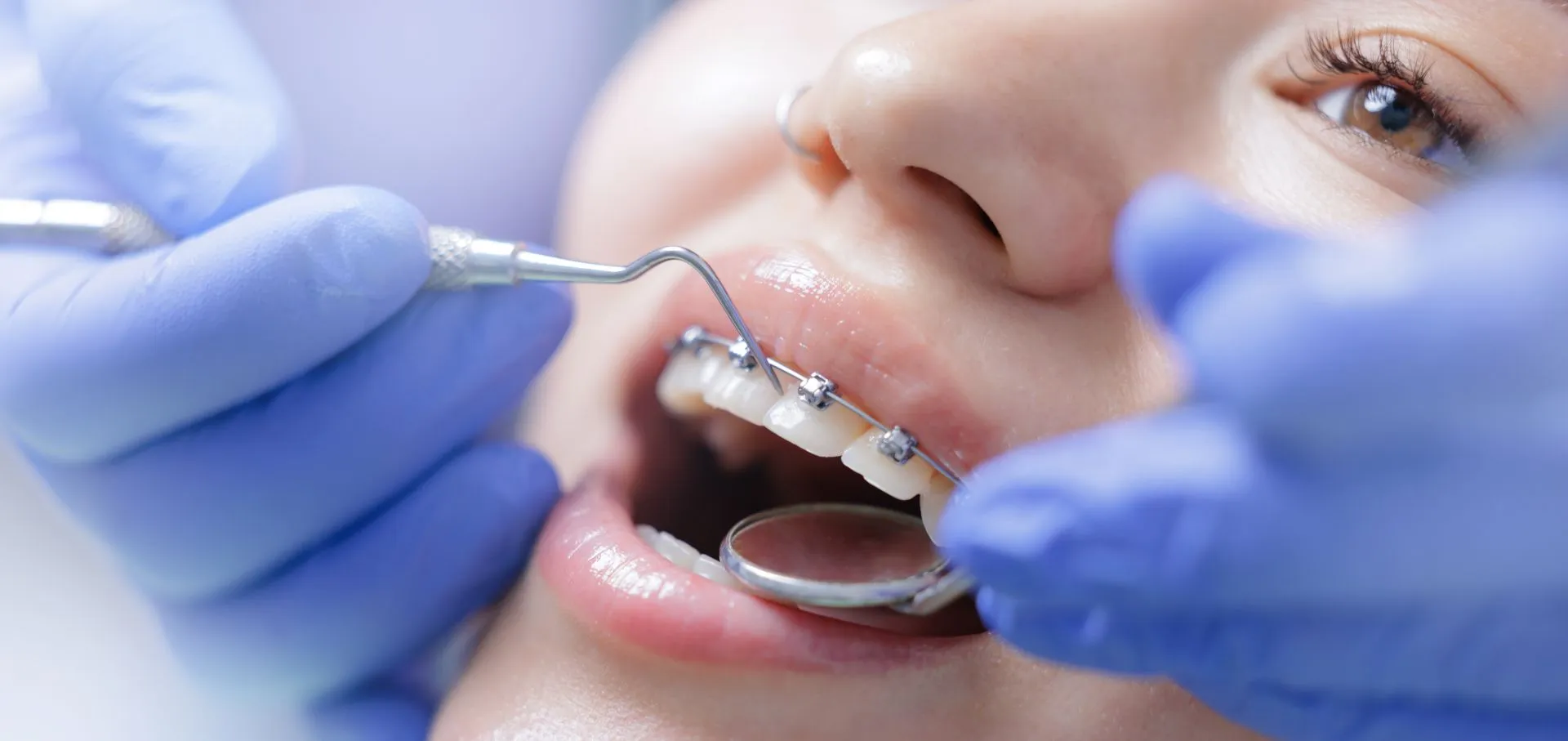 Close-up of metal braces on a patient's teeth during orthodontic treatment at Nova Dental Care of Chantilly