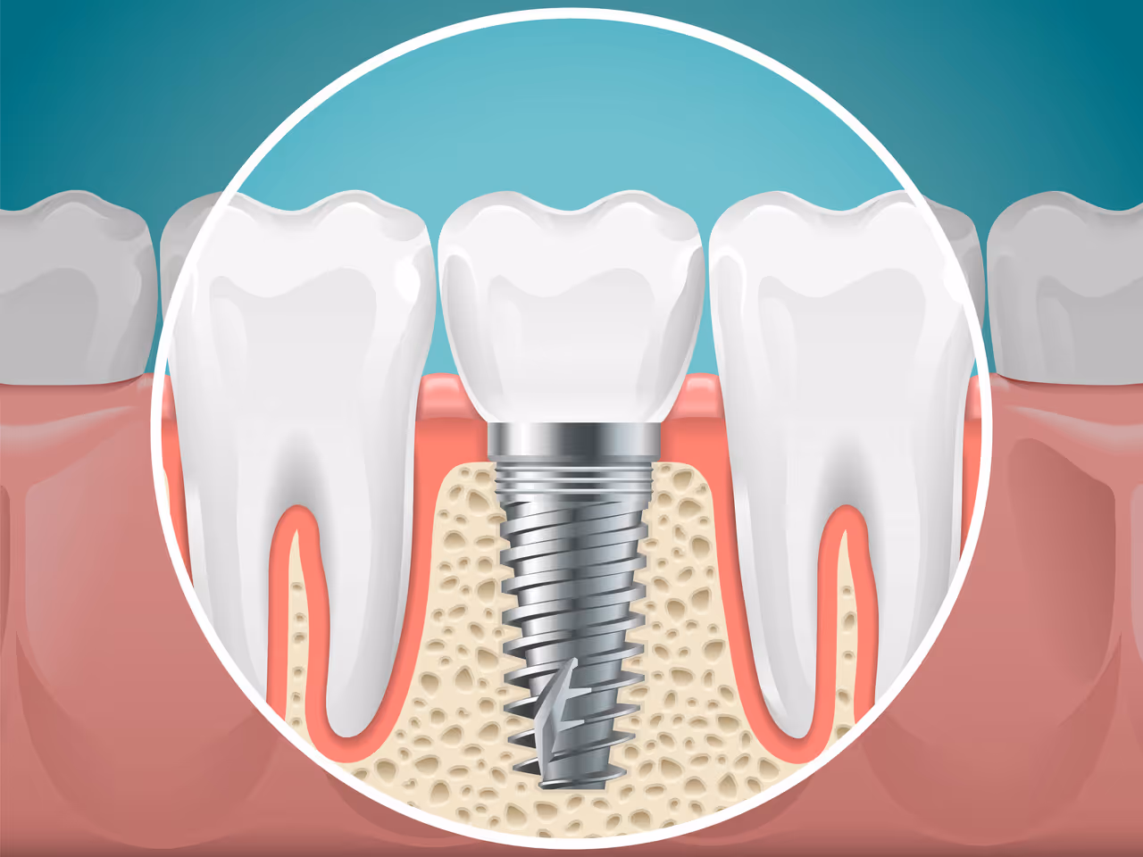 What Are the 3 Types of Dental Implants?