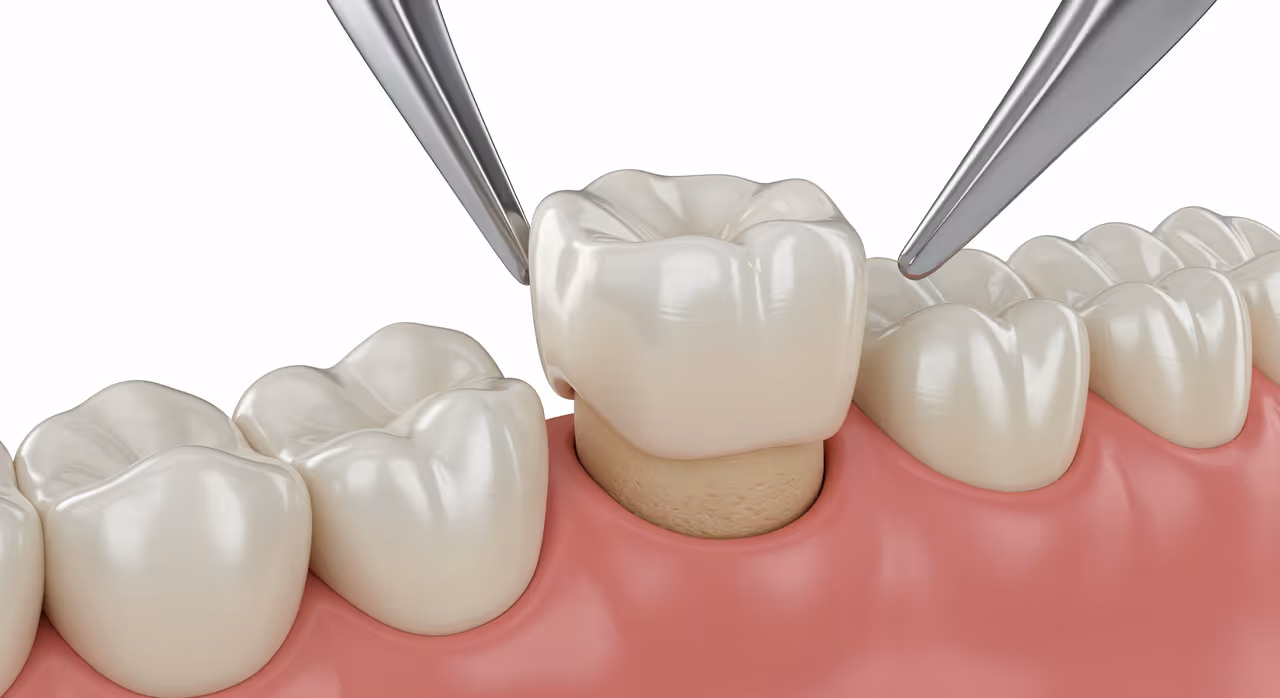 Do You Need a Dental Crown? Signs to Look For