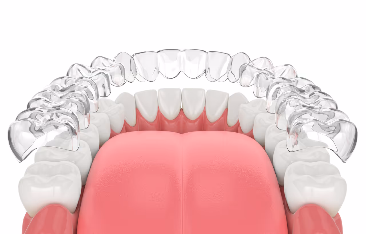 What Are Invisalign Retainers and Why You Need Them