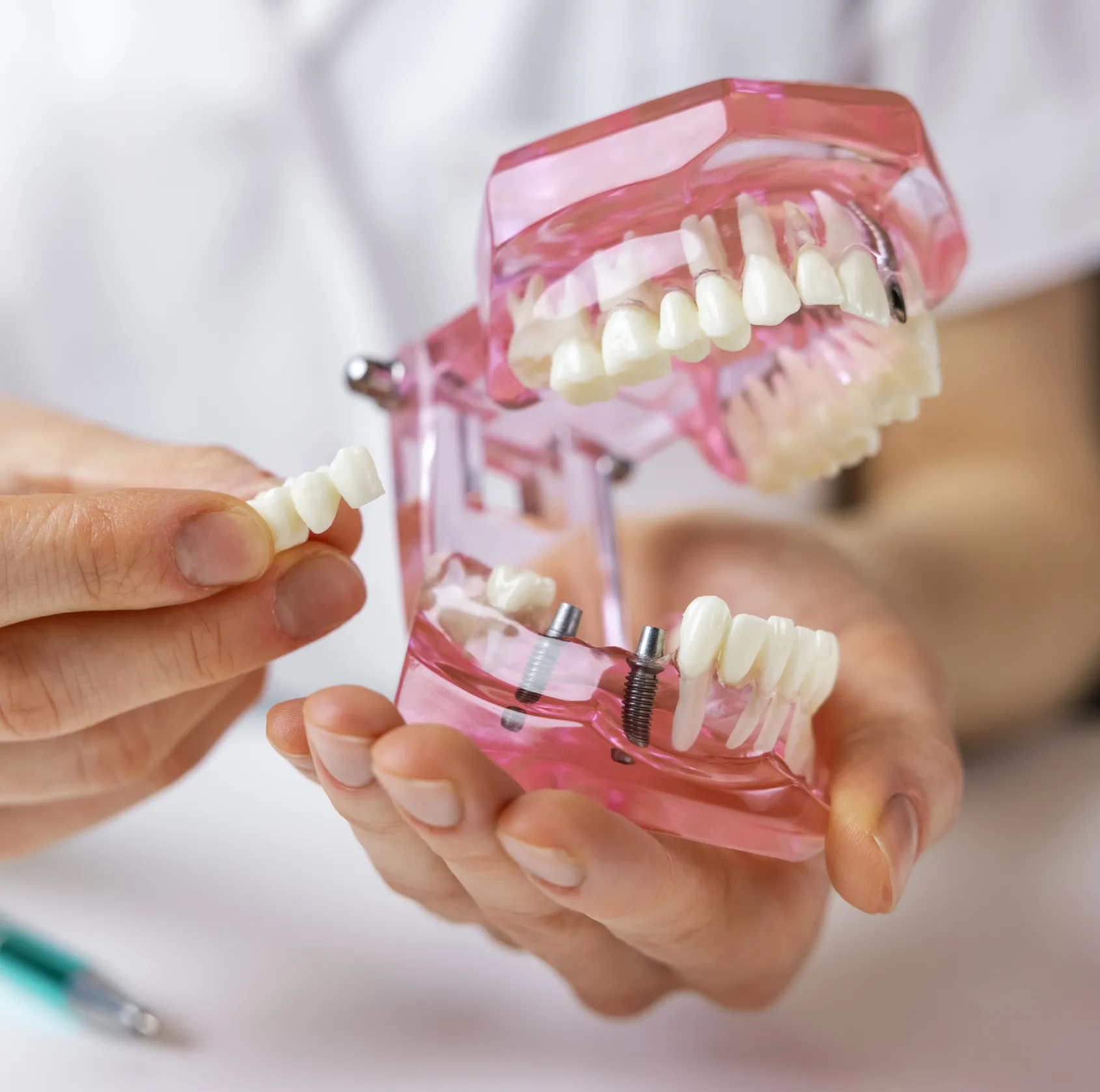 Hands holding dental model with implants and a dental crown bridge to be placed.
