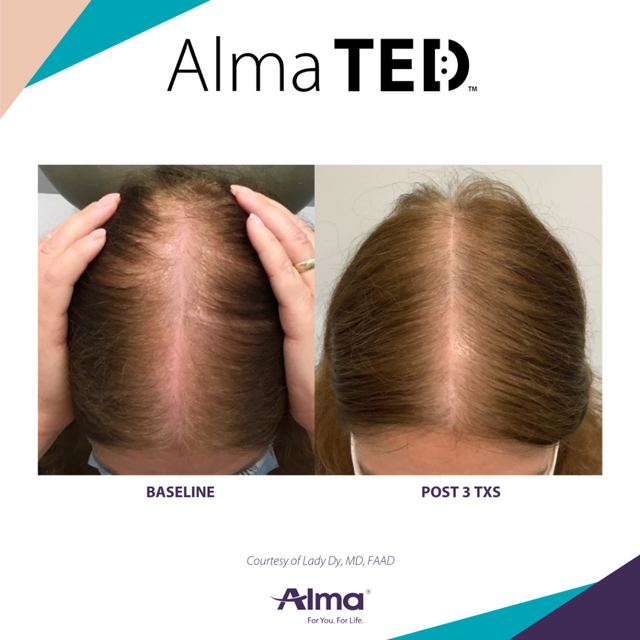 Side-by-side comparison showing the top of a woman's scalp before and after three treatments with Alma TED, demonstrating noticeable hair regrowth.