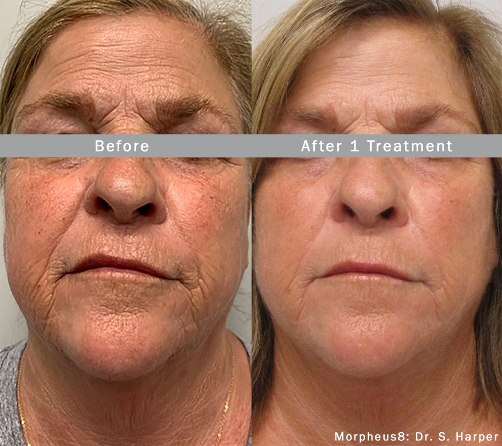 Side-by-side before and after images of a woman's face showing reduced wrinkles and smoother skin after one Morpheus8 treatment.