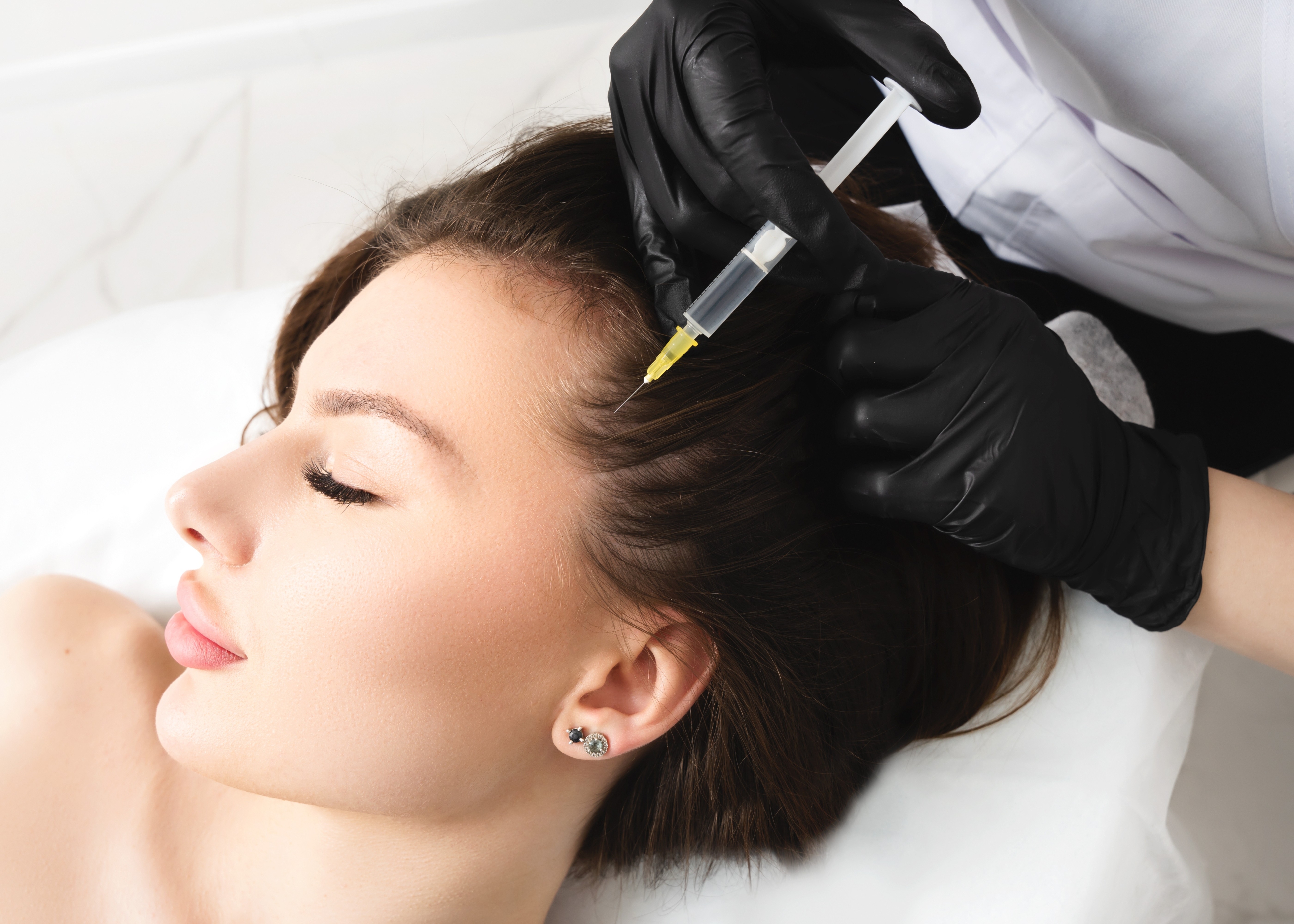 Close-up of a woman receiving a scalp injection with a syringe by a professional wearing black gloves.