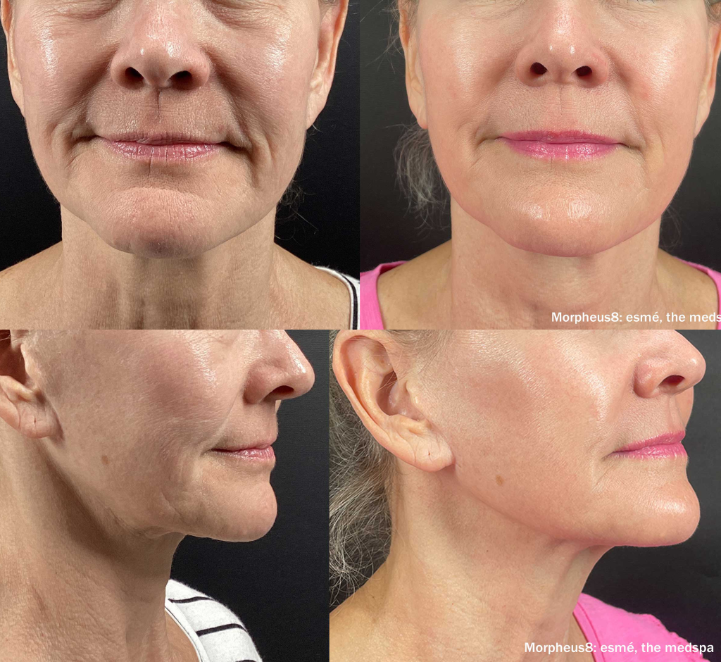 Before and after collage showing close-up views of a woman's lower face and neck; the after images display smoother skin and reduced wrinkles with makeup.