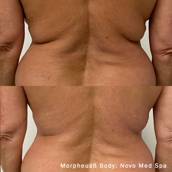 Before and after comparison of a person's bare back showing reduced fat and smoother skin after Morpheus8 Body treatment at Novo Med Spa.
